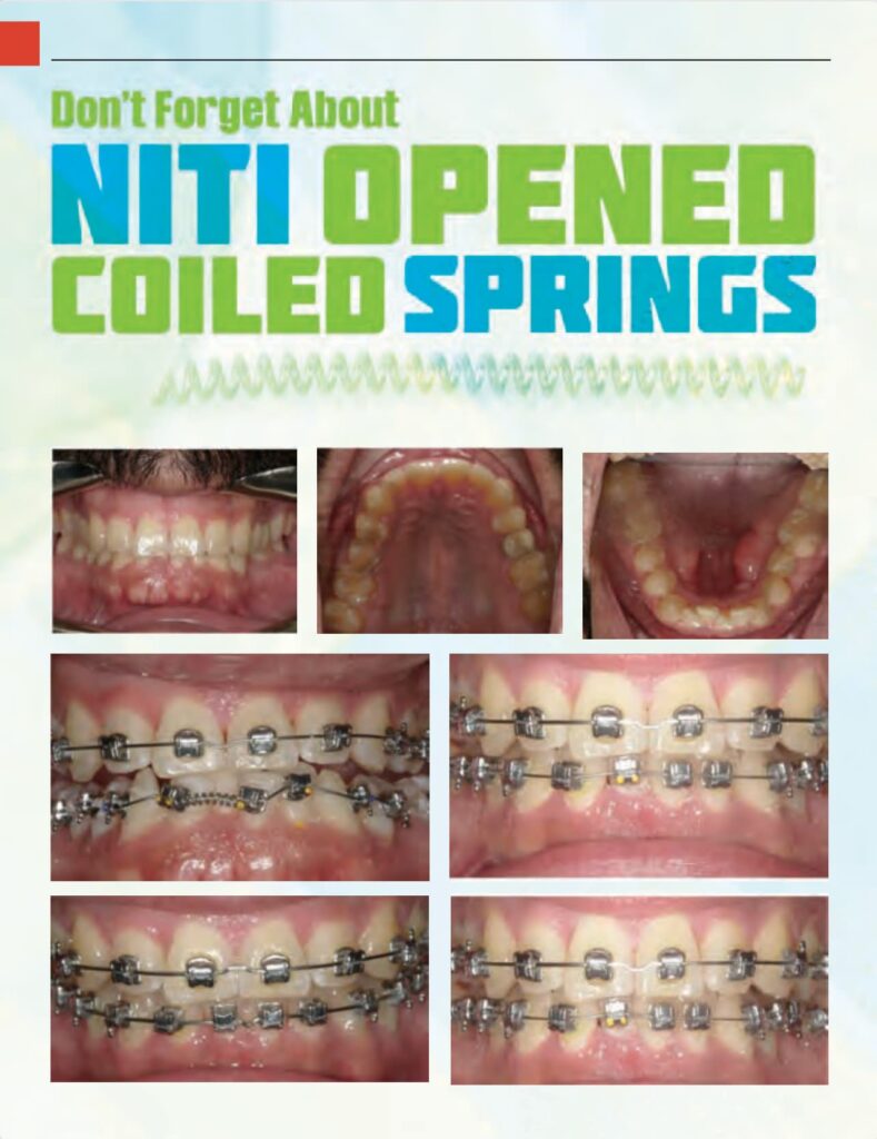 Don't Forget About Nite Opened Coiled Springs