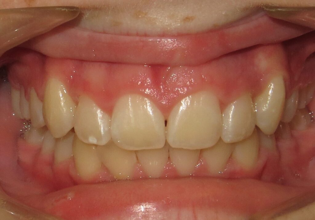 before and after | Orthodontic Teaching Institute