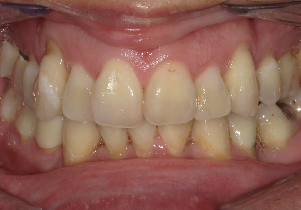 before and after | Orthodontic Teaching Institute