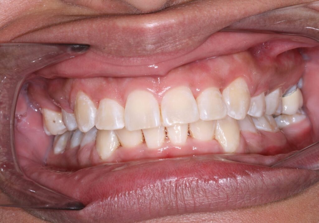 before and after | Orthodontic Teaching Institute