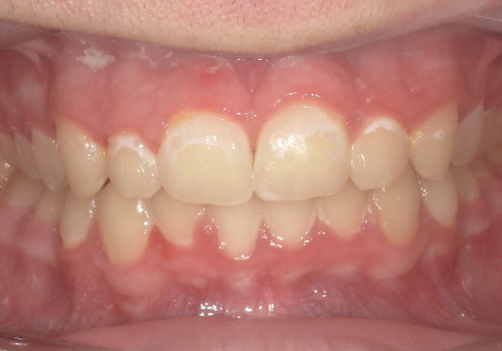 before and after | Orthodontic Teaching Institute