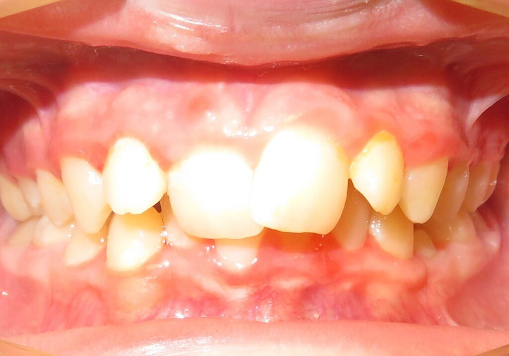 before and after | Orthodontic Teaching Institute